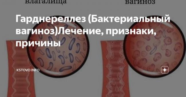 Симптомы бактериального вагиноза