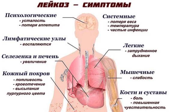 Лейкоз крови симптомы у взрослых анализ крови | 1analiz.ru