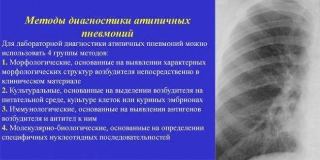 Бессимптомная пневмония: причины, признаки, лечение