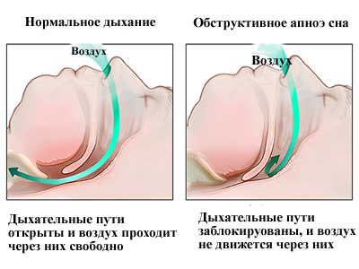 Апноэ — временная остановка дыхания во сне, при которой можно не проснуться
