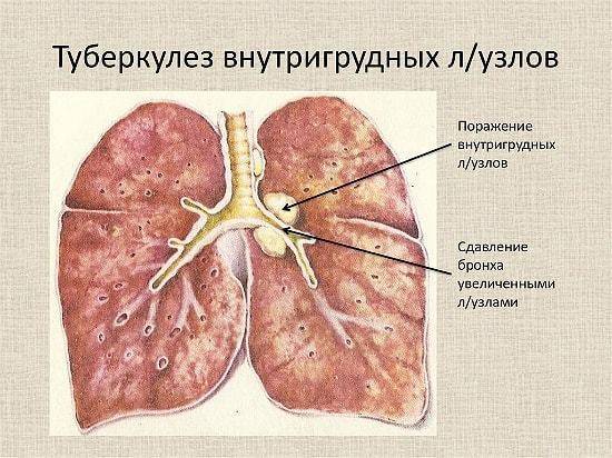 Туберкулез лимфоузлов: первые признаки и методы лечения