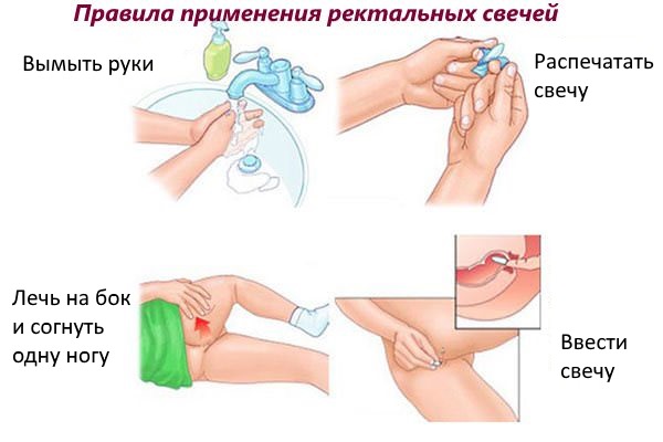 Проктозан свечи