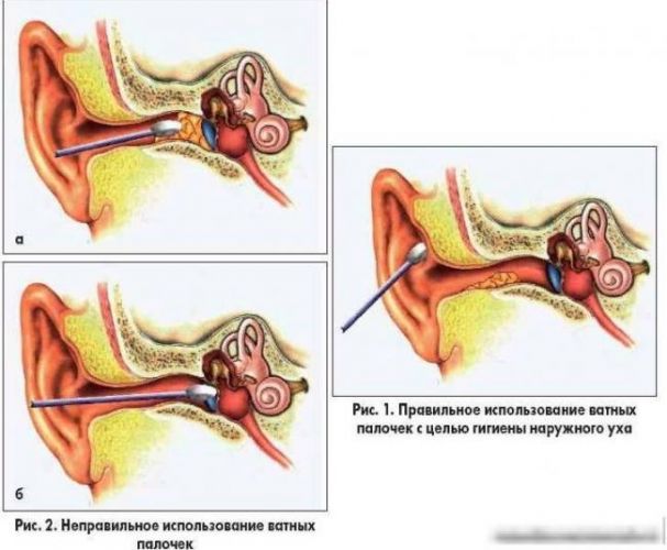 Как удалить серную пробку?