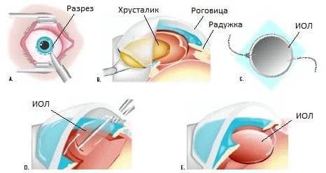 Как долго восстанавливается зрение после удаления катаракты