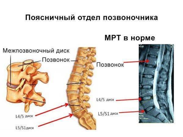Какие мази лучше помогают при грыже позвоночника