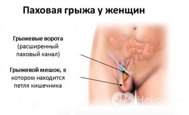 Паховая грыжа диета после операции