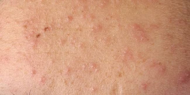 Ретиноевая мазь (retinoic ointment)