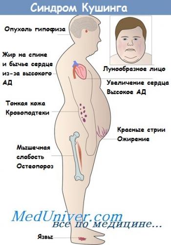Диагностика и лечение артериальной гипертензии при гиперсекреции глюкокортикоидов (синдром и болезнь иценко-кушинга)