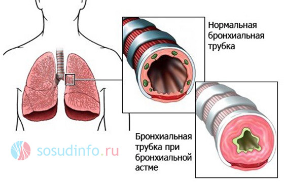 Если задыхаешься при сердечной недостаточности