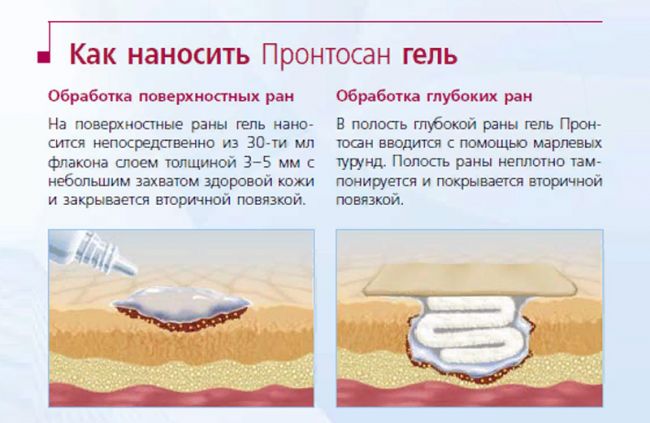 Правила применения геля пронтосан для заживления ран