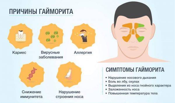Последствия прокола гайморовых пазух - как избежать осложнений
