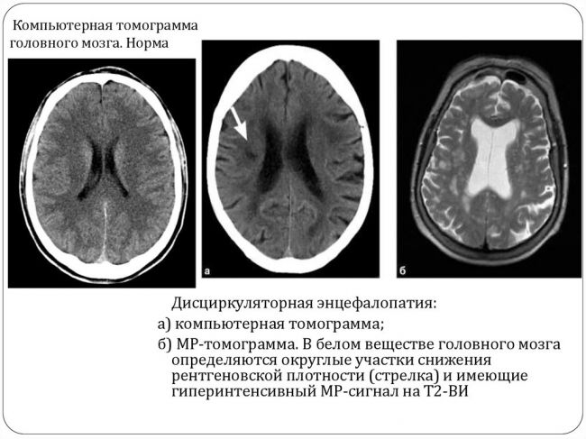 Что такое энцефалопатия и как ее выявить