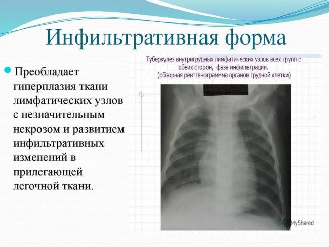 Туберкулез внутригрудных лимфатических узлов