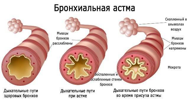 Первые признаки бронхиальной астмы: как не упустить момент
