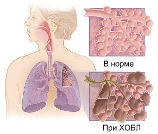 Наиболее эффективные антибиотики при пневмонии