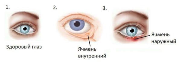 Как убрать ячмень с глаза быстро?