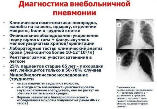 Пневмония без кашля: причины, симптомы, лечение
