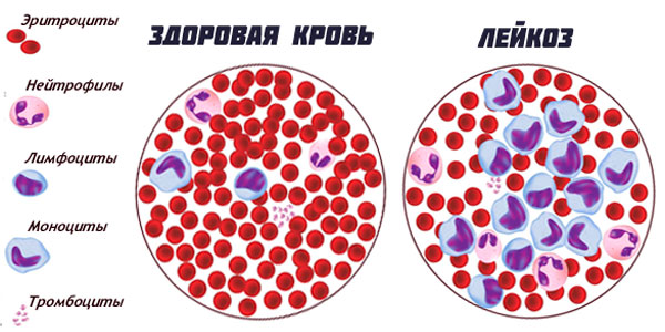 Анализ крови при лейкозе