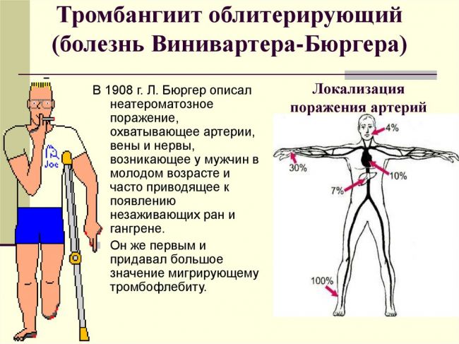 Симптомы и лечение болезни бюргера