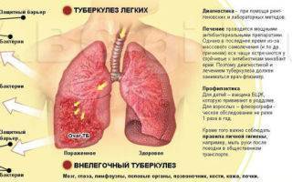 Какой бывает кашель при туберкулезе, его симптомы и лечение