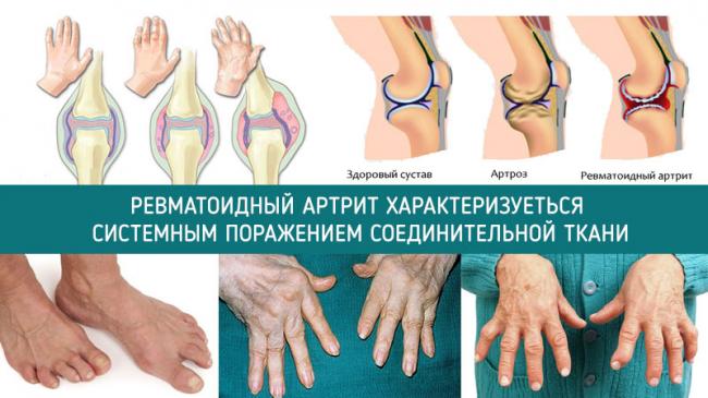 Лечение артрита на ногах, руках, голеностопа, коленного сустава народными средствами