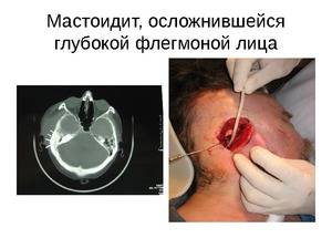 Киста сосцевидного отростка височной кости