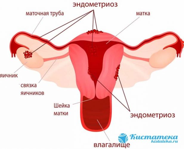 Правильное питание после лапароскопии кисты яичника
