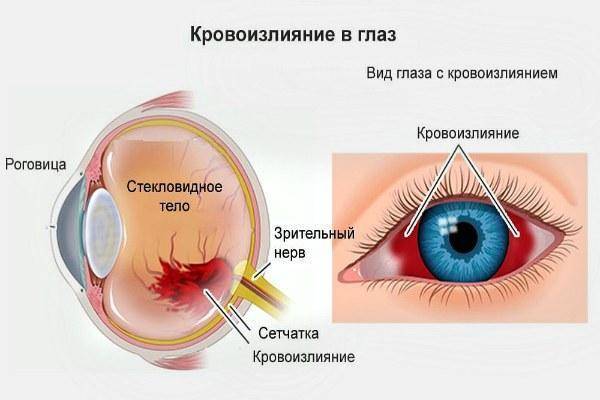 Кровоизлияние в глаз: что делать, причины и лечение, симптомы, диагностика