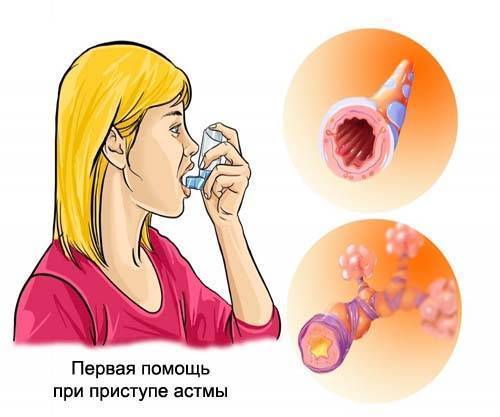 Приступ астмы: симптомы, что делать? как снять приступ больному без лекарств?