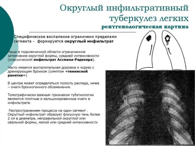 Очаговый туберкулез легких: симптомы, лечение | eurolab | инфекционные болезни