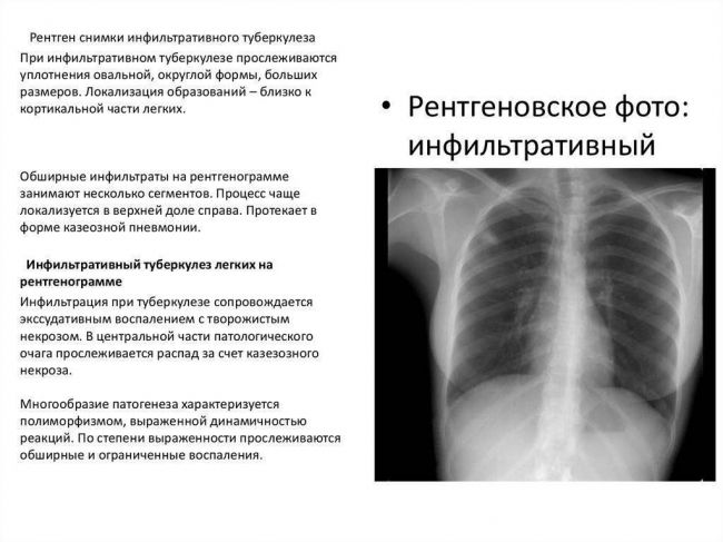 Рентген легких и флюорография легких — все что нужно знать