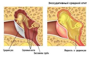 Гнойный отит у ребенка сколько дней лечится