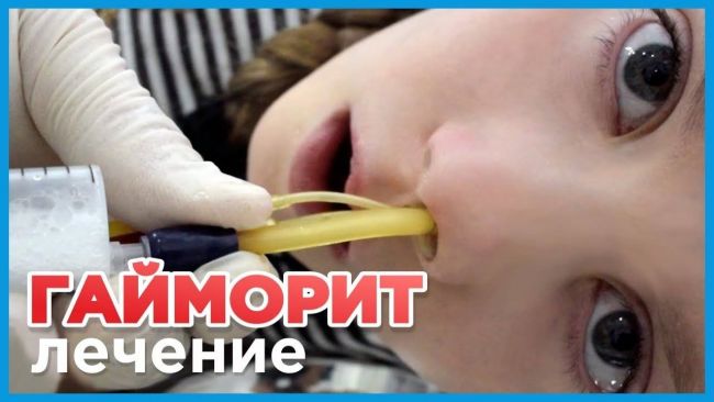 Как лечить гайморит без прокола в домашних условиях – можно ли вылечить
