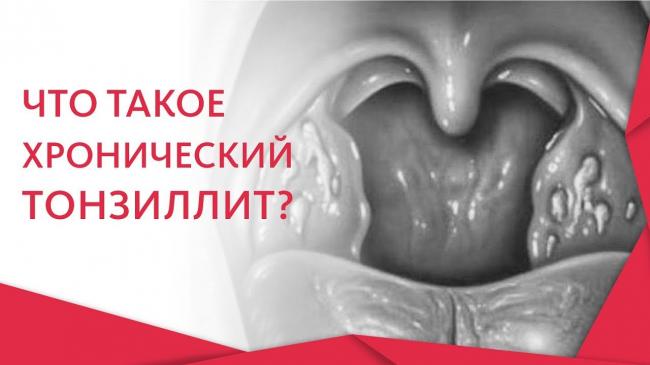 Как убрать пробки (камни) из миндалин при тонзиллите, чем лечить