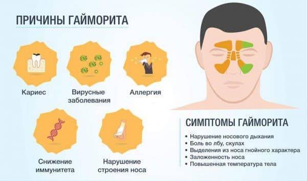 Последствия прокола гайморовых пазух - как избежать осложнений