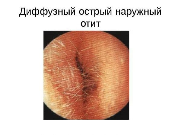 Острый отит: лечение и симптомы