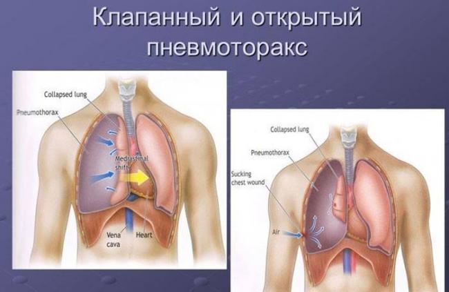 Открытая форма туберкулеза