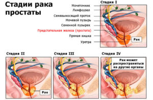 Питание при раке