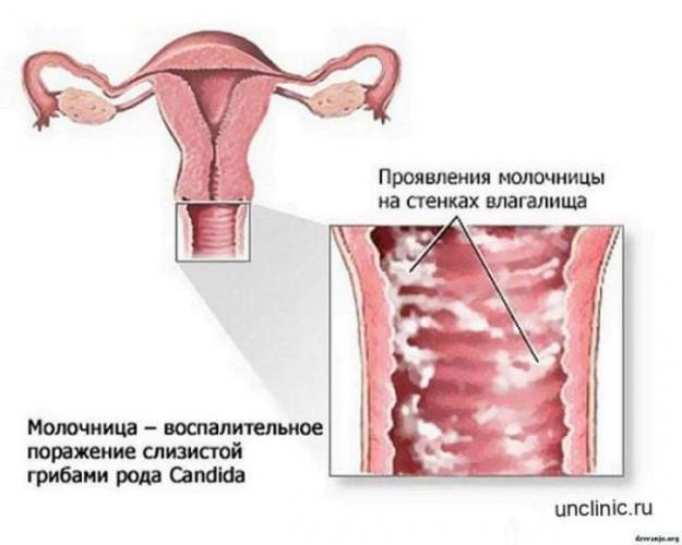 Вульвит. лечение, причины и симптомы вульвита у девочек и женщин.