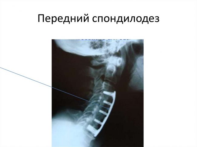 Спондилодез поясничного отдела позвоночника отзывы последствия