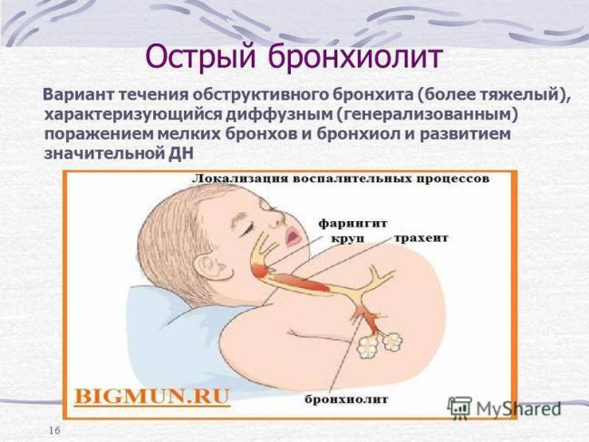 Лечение обструктивного бронхита у детей в домашних условиях: симптомы хронической формы, профилактика, особенности развития острой формы