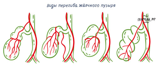 Симптомы и лечение деформирования желчного пузыря у детей