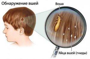 Грибок кожи головы заразен или нет