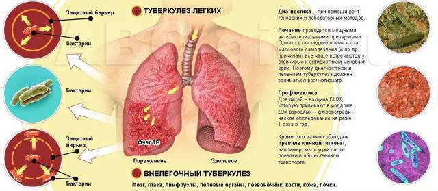 Как отличит кашель при туберкулезе и бронхите