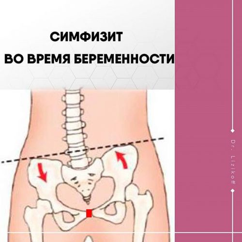 Симптомы и лечение симфизита при беременности