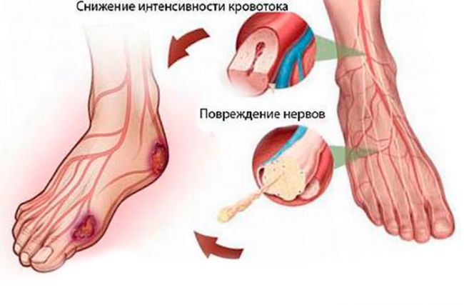 Что такое полинейропатия нижних конечностей и можно ли вылечить болезнь?