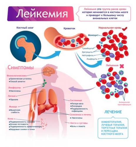 Анализ крови при лейкозе