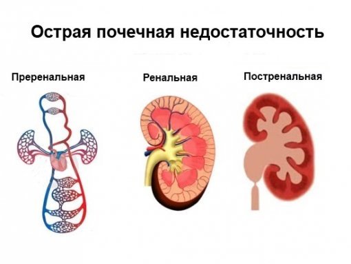 Нефросклероз почек лечение
