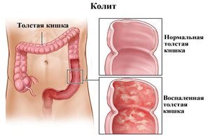 Диета при гастрите колите язве желудка