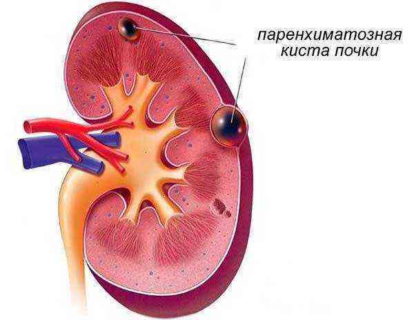 Диета при болезнях почки кисте почки